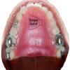 RPE Tongue Guard: Prevents and Helps Heal Tongue Sores Caused by Dental Expanders view 2