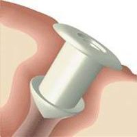 6611 Plug Softplug Ophthalmic Silicone Mini .5mm Punctum 2 Per Box Part No. 6611 by- Oasis Medical