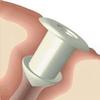6611 Plug Softplug Ophthalmic Silicone Mini .5mm Punctum 2 Per Box Part No. 6611 by- Oasis Medical view 1