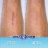 Scar Zone Advanced Scar Removal Cream - Scar Cream for Surgical Scars, Stretch Marks Removal, C Section & Fades Old & New (0.75 oz, Pack of 2) view 4