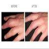 Scarfade silicone scar gel for scar removal, scar therapy - 30g Tube view 3