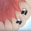 10 Pcs SmileTech New Bite Turbos Dental Orthodontic Materials view 3