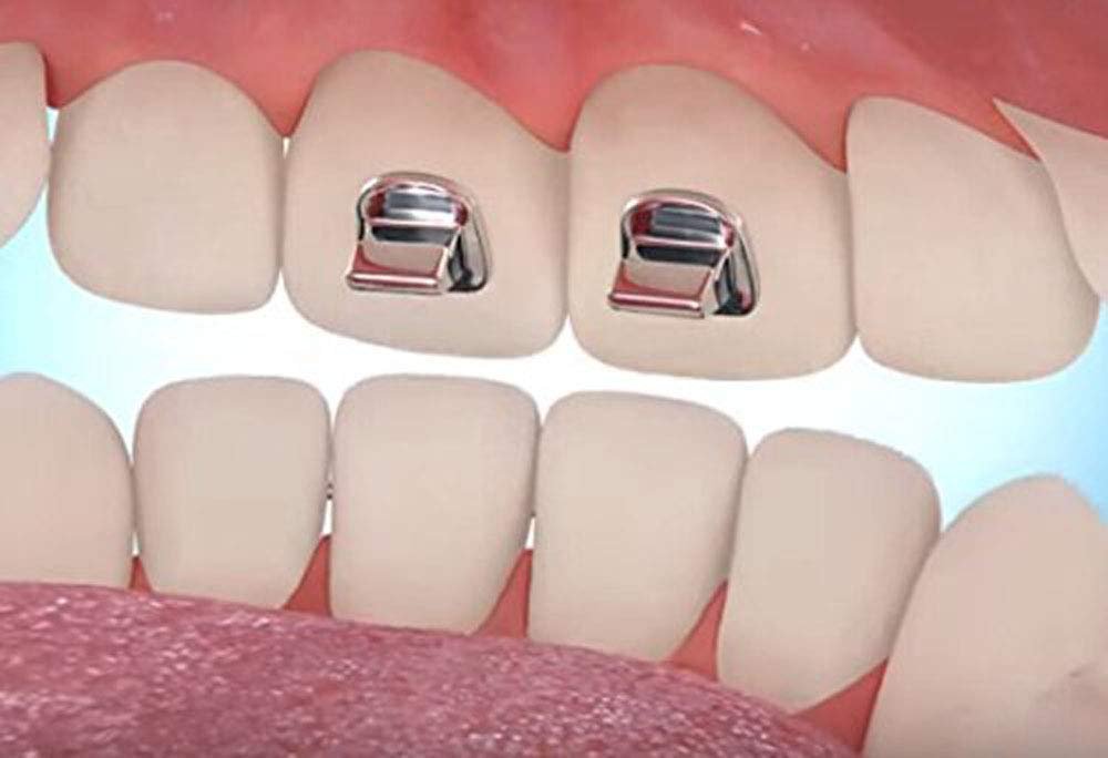 20 Pcs New Bite Turbos Dental Orthodontic Materials