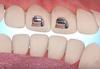 20 Pcs New Bite Turbos Dental Orthodontic Materials view 1