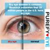 PUREFYEYE (Bundle) Eyelid Daily Cleanser for Relief from Dry Eyes, Itchy Skin, Rosacea, Pink Eyes. Gentle, Non-irritating and Hypoallergenic. (8ml, 1.7oz, 4oz) view 4