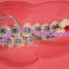 faruijie Colourful Elastic Power Chain for Braces Dental Orthodontic Powerchains 3 Sizes Ortho Rubber Band(Short,Purple 28#) view 2