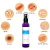 Topical Probiotic Spray For Skin - 13 Strains Live Probiotic Skin Care Dermatic Biome Acne Folliculitis Supplement Dermatitis Rosacea Eczema Treatment Body Face Mist Sprayable Deodorant Microbiome view 2