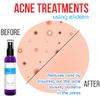 Topical Probiotic Spray For Skin - 13 Strains Live Probiotic Skin Care Dermatic Biome Acne Folliculitis Supplement Dermatitis Rosacea Eczema Treatment Body Face Mist Sprayable Deodorant Microbiome view 4
