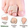 Welnove 6Pcs Hammer Toe Straightener, Hammer Toe Splints, Toe Wraps Cushioned Bandages for Correcting Hammer Toes, Broken, Bent, Curled, Crooked & Overlapping Toes (Beige) view 3