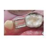 J&J Ortho Preformed Space Maintainer Band & Loop (4/pk) (#36) view 3