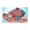 J&J Ortho Preformed Space Maintainer Band & Loop (4/pk) (#36) view 4