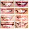 Teeth Whitening Gel Syringe Dispensers 44% Carbamide Peroxide, Tooth Bleaching Gel Multiple Quantities Available and Size Available (3 ml, 10) view 3