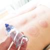 2PCS Cupping Therapy Device Cupping Vacuum Suction Cups Cupping Massage Back Tool Chinese Cupping Therapy Pump Hijama Physical Therapy Cup Blue view 2