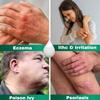 Barmicil Plus Maximum Strength 1% Hydrocortisone Cream, Intensive Anti-Itch & Relief for Eczema, Psoriasis, Rash, Bug Bites, Poison Ivy, Paraben-Free Formula with Soothing Aloe Vera, 1 oz. Tube view 3