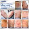 LMNOOP Eczema Cream for Dry, Itchy, Irritated, and Eczema Prone Skin, Maximum Strength Treatment Ointment for Rash, Psoriasis, Dermatitis 3.53oz view 2