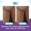 Breast Surgery Recovery Supplies - Silicone Sheets for Healing - Augmentation Essentials - Comfortable Under Post-Op Bra view 3