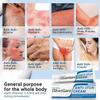 ishancare Anti Itch Soothing Cream Extra Strength Skin Itch Relief Ointment, for Full Body Itching Caused by Seasonal Changes, Dermatitis, Eczema, Rash, Psoriasis, Hives, Bites, Poison Ivy, 1.76 oz view 3