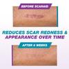 ScarAid Silicone Scar Gel Stick 17g  Mess-Free, Premium-Grade Scar Treatment  Helps Improve the Appearance of Old & New Scars from Surgery, Injury & Acne - Non-Greasy & Gentle on All Skin Types view 4