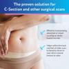 ScarAway Advanced Silicone Scar Sheets for C-Section, Reusable Strips (1.5 x 7) for Hypertrophic and Keloid Scars from C-Section & Other Surgeries, 4 Sheets view 2