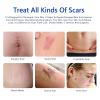Scar Cream, Scar Removal Cream - Advanced Scar Cream for Surgical Scars, Acne Scars, C-Section, Burns, Stretch Marks -Effective for Old and New Scars Gel Acne Scar Treatment view 3