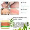 Draw Salve Eczema Cream Athlete's Itchy Foot Relief, Heat Rash, Anus Itch, Tinea Versicolor, Armpit, Lichen Planus, Cyst Removal Patch, Splinter Boil Ease, Ingrown Hair, Chigger, Carbuncle, Pilonidal view 3