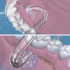 Professional Replacement Tips for Waterpik Water Flosser - 6 Implant Denture Tips view 3