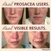 Prosacea - Heals Rosacea Symptoms of Redness, Pimples and Irritation - 0.75 oz (Pack of 2) view 2