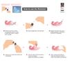 E&E Denture Reline Silicone Remover_Effective silicone reliner removal from an acrylic denture. Quick 10 seconds!!! view 4