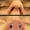 Nostril Retainer Short Model | Nostril Retainer Rhinoplasty | Nasal Retainer Rhinoplasty & Nose Splint for Rhinoplasty Recovery | 100% High Grade Silicone | Nose Retainer Size (9) view 2