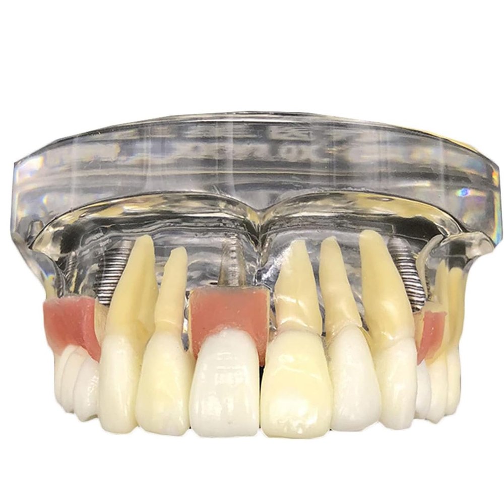 HENLYEN Dental Typodont Model Implant Restoration Tooth Model, Maxillary Implant Study Analysis Demonstration Teeth Model with Removable Teeth and Soft Gum for Study Teaching. , Skin