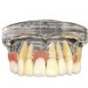HENLYEN Dental Typodont Model Implant Restoration Tooth Model, Maxillary Implant Study Analysis Demonstration Teeth Model with Removable Teeth and Soft Gum for Study Teaching. , Skin view 1