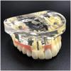 HENLYEN Dental Typodont Model Implant Restoration Tooth Model, Maxillary Implant Study Analysis Demonstration Teeth Model with Removable Teeth and Soft Gum for Study Teaching. , Skin view 2