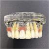 HENLYEN Dental Typodont Model Implant Restoration Tooth Model, Maxillary Implant Study Analysis Demonstration Teeth Model with Removable Teeth and Soft Gum for Study Teaching. , Skin view 4