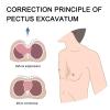 HMWOKPOT Pectus Excavatum Funnel Chest Brace, Thoracic Depression Brace Correction Principle of Pectus Excavatum for Kids Men Women,15cm view 2