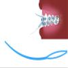 AmeriCan Goods Orthodontic Floss Threaders Blue Curved Smooth Edges Dental Floss Threader for Braces, Bridges, and Implants (100) view 4