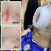 Exemic Pectus Excavatum Vacuum Bell - Pectus Excavatum Orthosis Brace,Physical Correction,Washable,Real-Time Pressure Monitoring,Easy to Operate(S-S) view 4