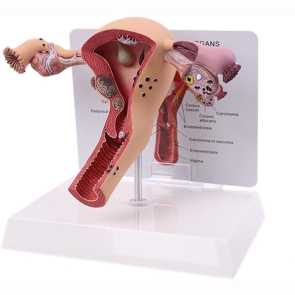 Female Uterus Ovary Model, Pathology Model of Human Female Uterus Ovary Disease Dissection Biology Teaching Aid Anatomy Lesion Uterus