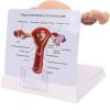 Female Uterus Ovary Model, Pathology Model of Human Female Uterus Ovary Disease Dissection Biology Teaching Aid Anatomy Lesion Uterus view 3
