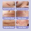 Ourmed Silicone Scar Removal Sheets (1.6" x 6", Pack of 5) Medical Grade Silicone Scar Removal Sheets, Hypoallergenic for New and Old Scars Surgery, Burns, Acne, Keloids, Stretch Marks, C-Section view 2
