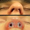 Nostril Retainer | Nostril Retainer for Rhinoplasty Recovery | Nose Retainer for Surgery | Nose Shaper & Support Device | 100% High-Grade Silicone | Post-Surgery Nostril Shaping & Recovery Aid (6) view 4