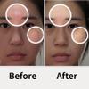 AD SOLUTION Ato Fast Calming Patch for Skin Redness, Itching & Flare-Ups Soothing Hydrogel for Sensitive Skin with Cica & Panthenol 10 Pairs view 2