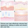 Silicone Scar Sheets For Face Wrinkles, Scars- Reusable Scar Removal Strips, Scar Tape view 3