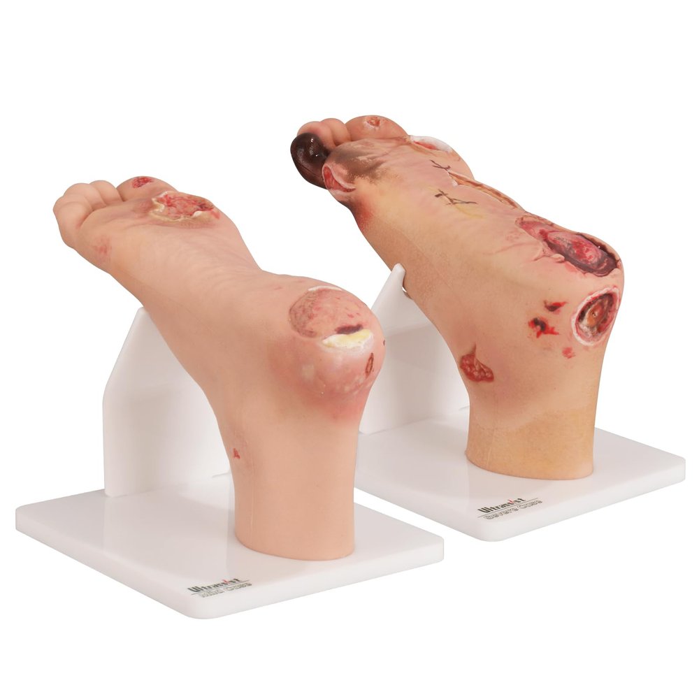 Ultrassist Diabetic Foot Ulcer Model Set - Anatomical Accuracy for Mild & Severe Stage Pathology Study - Medical Training Tool for Healthcare Professionals