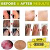 BaiSntg 5Pcs Chinese Herbal Eczema Psoriasis Creams Dermatitis and Eczema Pruritus Psoriasis Ointment view 2