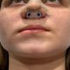 Nostril Retainer Rhinoplasty | Nose Splint After Rhinoplasty | Nasal Retainer | Nose Shaper & Support Device 100% Silicone | Comfortable Nostril Shaping After Surgery | Nose Retainer (7) view 3
