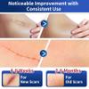HBM Medical Grade Silicone Scar Tape, Scar Silicone Strips,Silicone Scar Sheets for Surgical Scars, C-Section, Keloid, Burn, Acne, Reusable Scar Removal Tape for Old & New Scars (4 x 150 cm) view 3