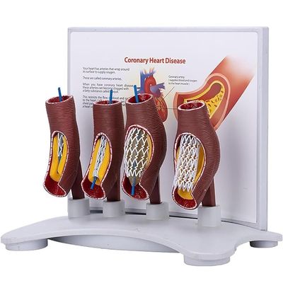 Human Coronary Stent Model, Vascular Blockage Model, Vascular Stent Anatomical Model, Human Vessel Enlargement Demonstration Model