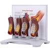 Human Coronary Stent Model, Vascular Blockage Model, Vascular Stent Anatomical Model, Human Vessel Enlargement Demonstration Model view 1