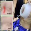 QUGURLID Pectus Excavatum Orthosis Brace,Pectus Excavatum Vacuum Bell,Pectus Excavatum Orthosis Brace,Chest Support,w/Pressure Gauge (197) view 4