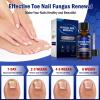 Toe Nail Fungus Renewal, 2-Pack Toenail Fungus Renewal, Fast Acting For Thick, Discolored, Broken & Damaged Toe & Finger Nail view 4